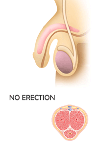 Erection Problems Treatment